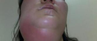 Абсцесс челюсти и околочелюстной абсцесс симптомы и лечение Подбородочный абсцесс